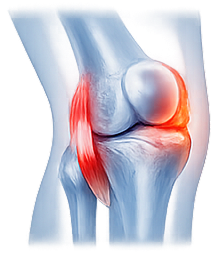 Mcl Injuries