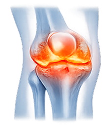 Knee Arthritis