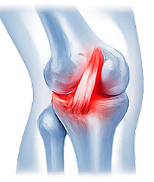 Acl Injuries