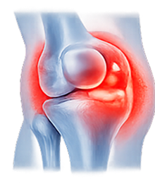 Knee Swelling