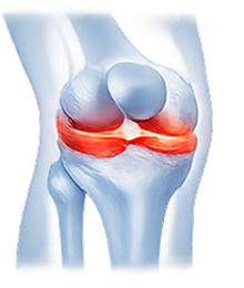 Meniscus Injuries